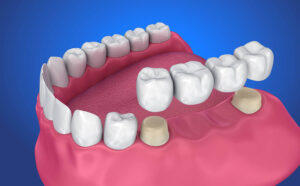 Fixed prosthodontics